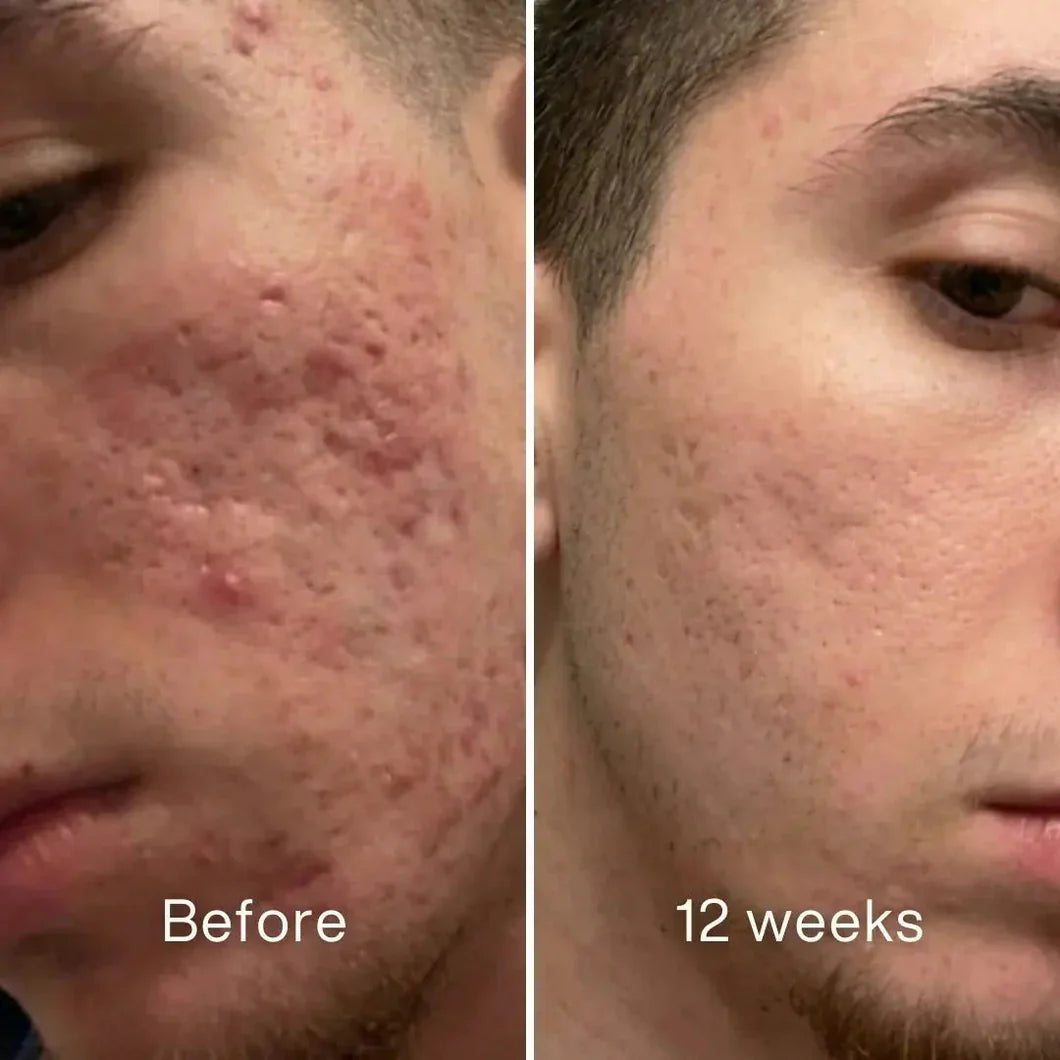 Clinical Acne Scar Repair Stick™