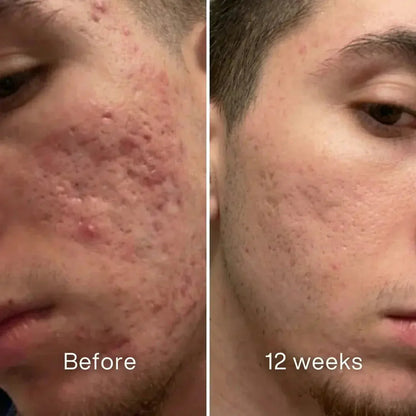 Clinical Acne Scar Repair Stick™